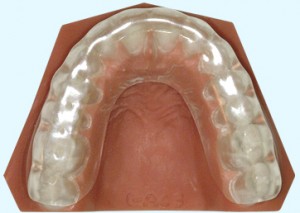 Occlusal Split/Orthosis Used to treat TMD. 