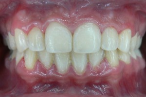 After (teeth #6-11)