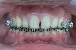 Before (teeth #6-11)
