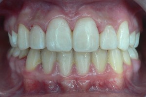After (Teeth #7-10)