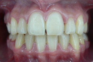 Before (teeth #7-10)