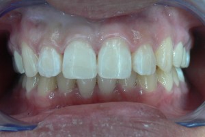 After (teeth #8)