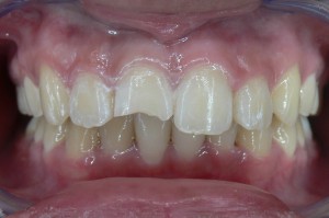 Before (teeth #8)
