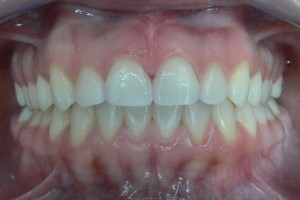 After (teeth #8-9)