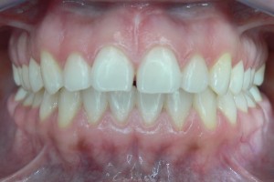 Before (teeth #8-9)